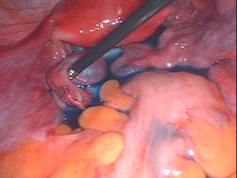 testing tubes after removing ovarian cyst